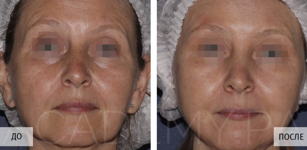 Фотографии до и после лазерного омоложения лица, проводим в клинике Premium  Aesthetics