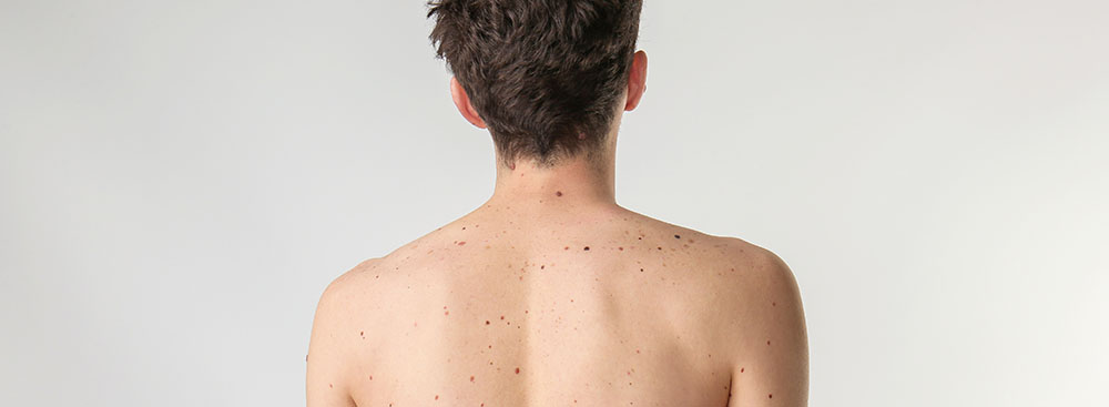 Фотолечение кожи спины